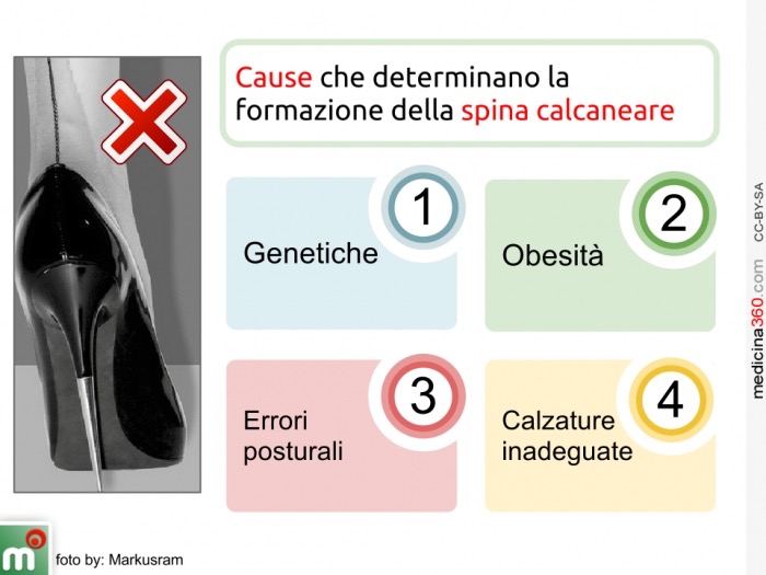 Risultati immagini per spina calcaneare